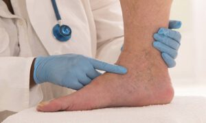 Chronic venous disease - Ban