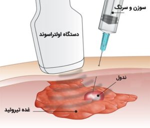 نمونه برداری تیرویید