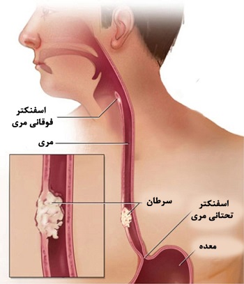 دیسفاژی (بلع دردناک)