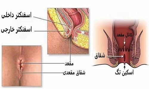 فیشر (شقاق)