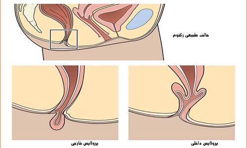 پرولاپس رکتوم در بزرگسالان
