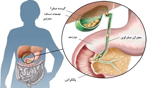 سگ کیسه صفرا