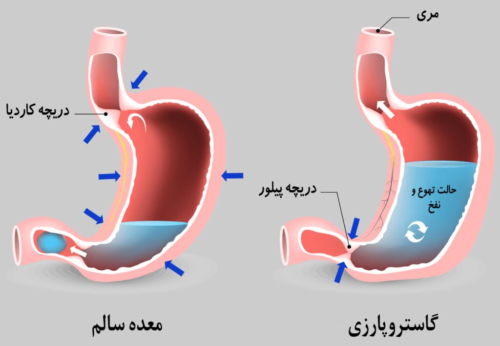 بیماری گاستروپارزی