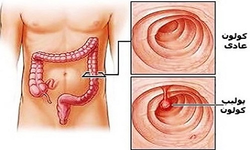 پولیپوز آدنوماتوی فامیلیال (FAP)