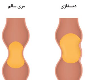 دیسفاژی (بلع دردناک)