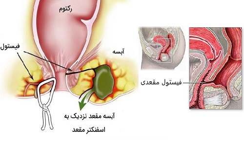 آبسه و فیستول آنال (مقعدی)
