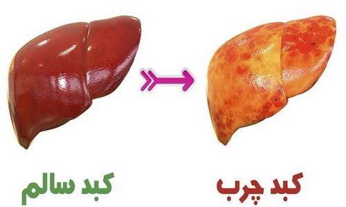 تغذیه در کنترل بیماری کبد چرب